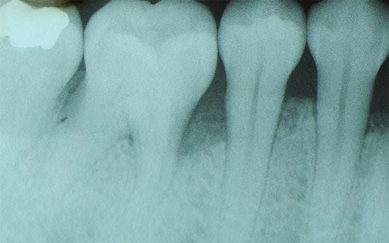 SOSTITUZIONE-DENTI-NAT-CON-IMPIANTI-1