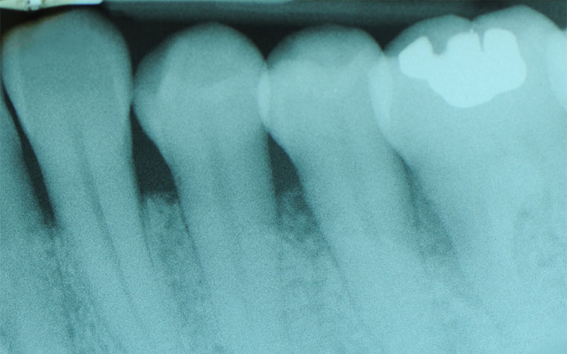 SOSTITUZIONE-DENTI-NAT-CON-IMPIANTI-2