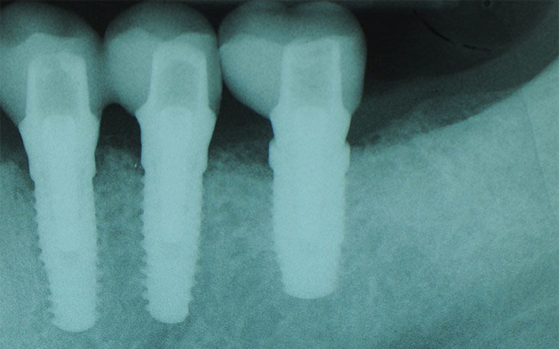 SOSTITUZIONE-DENTI-NAT-CON-IMPIANTI-7