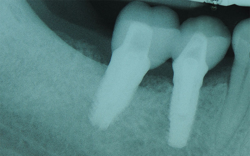 SOSTITUZIONE-DENTI-NAT-CON-IMPIANTI-8